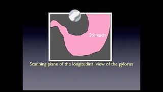 Pyloric Stenosis [upl. by Rihaz]