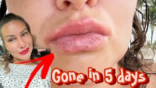 Angular Cheilitis gone in 5 daysLip eczemacracked lips red corners mouth SHOCKING FAST RESULTS [upl. by Elane]