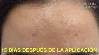 Aplicación de Botox en Parálisis Facial [upl. by Quillon]