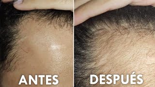 Recuperé El Pelo En Entradas Y Temples En 3 Meses [upl. by Rollie]