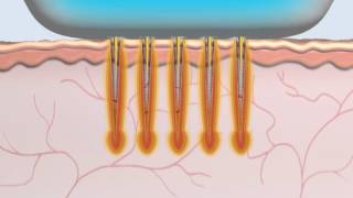 Animation Radiofréquence MicroNeedle Secret [upl. by Harrad267]