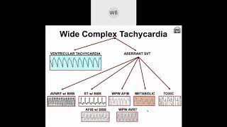 Wide Complex Tachyarrhythmias Part 1 Origins of VTach amp SVT with Aberrancy [upl. by Ecinnej]