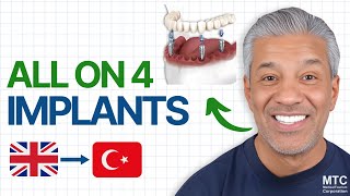 All on 4 Dental Implants in Antalya Did this UK Citizen Take the Right Decision [upl. by Singband329]