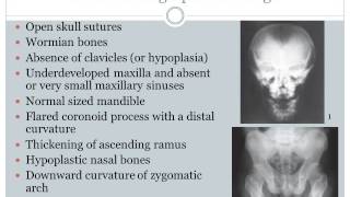 Cleidocranial Dysplasia [upl. by Izogn]