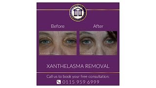 Xanthelasma Removal with Dr Maini [upl. by Conlee]