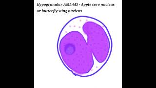 Difference between microgranular and hypergranular variant of AMLM3 APML  Pathology for all [upl. by Arreip]