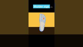 Mulder sign footpain medical health [upl. by Nnayllas]