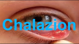 ChalazionSymptoms and CausesManagement and TreatmentPrevention [upl. by Helaine]