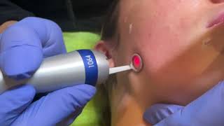 PicoWay Resolve Laser Facial in action [upl. by Nev772]