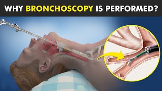 Bronchoscopy  Procedure To View Inside Of Air Ways [upl. by Redyr]