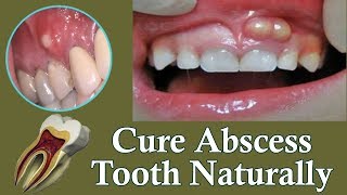 Best Treatment For Tooth Abscess  Cure Your Abscess Naturally At Home [upl. by Cut]