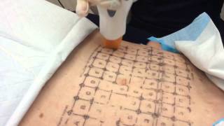 Thermage Treatment of the Abdomen  Dr Michael Kaminer [upl. by Peugia]