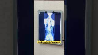 Kyphoscoliosis treatment by DrRavi scoliosistreatment kyphosis spine chiro short reeltrending [upl. by Reyna]