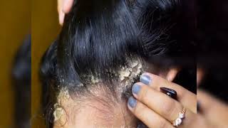 The Ultimate Guide to Treating Severe Dandruff [upl. by Eintroc346]