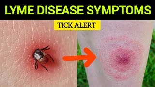 Early Signs of Lyme Disease What to Watch For [upl. by Belamy]