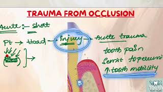 Trauma from occlusionTFO Periodontics lectures part 1 [upl. by Elinor]