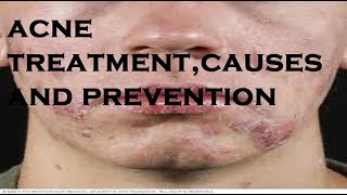 acne treatmentcauses and prevention [upl. by Emanuele]