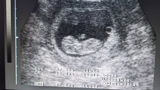 Early Pregnancy Scan  Obs Scan ultrasound [upl. by Aicella220]