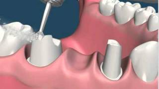 Dentista Puente Fijo de 3 unidades wwwdentistamonterreymx [upl. by Clementine]