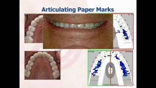 What is the TScan™ Computerized Occlusal Analysis System [upl. by Ahtinak]