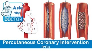 Percutaneous Coronary Intervention PCI [upl. by Marlette]