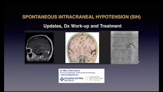 693 Síndrome de Hipotensión Intracraneal Espontánea el gran desconocido [upl. by Allecram]