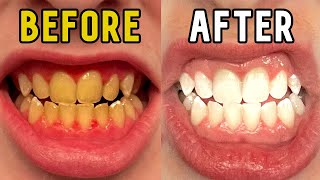 How I Whitened My Teeth in 14 Days [upl. by Eintihw]