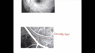 Normal Fluorescein AngiogramOphthalmology [upl. by Oj787]