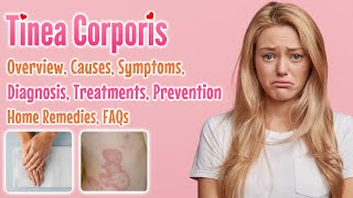 Tinea corporis overview causes sign and symptoms diagnosis treatment home remedies and FAQs [upl. by Arutek134]