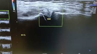 Knee Ultrasound  Meniscus tear  Sonography [upl. by Ttekcirc928]