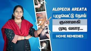 Alopecia Areata Treatment at Home in Tamil  தலை முடியில் புழு வெட்டு  பூச்சி வெட்டு தீர்வுகள் [upl. by Erodavlas]