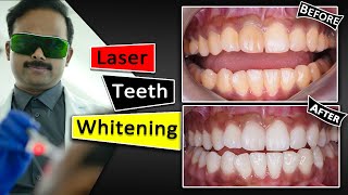 Teeth Whitening With Laser  Fastest amp Safest way [upl. by Zipah]