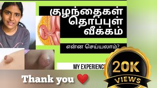 குழந்தைகளின் தொப்புள் வீக்கம் என்ன செய்யலாம் செய்யக்கூடாது  what is umbilical hernia how to cure [upl. by Ttirb]