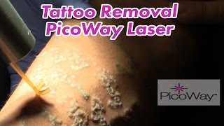 Tattoo Removal with PicoWay Laser System [upl. by Brookes968]