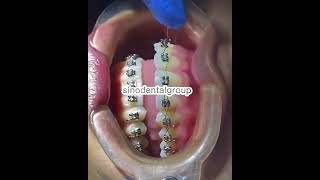 How to put braces ligature wire Sino Dental Group [upl. by Boucher]