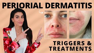 Perioral Dermatitis Triggers amp Treatment Recommendations by a Dermatologist [upl. by Field]