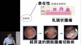 膀胱がんの治療方針 “膀胱がん、その治療選択肢を知る” 菊地 栄次 [upl. by Akimahs]