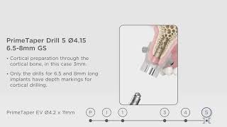 Guided surgery DS PrimeTaper Implant System [upl. by Nirahs584]