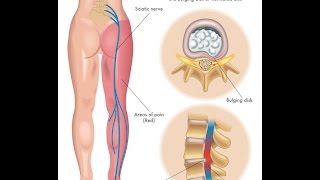 What is Sciatica [upl. by Ahar51]