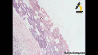 Pleomorphic adenoma [upl. by Inad]