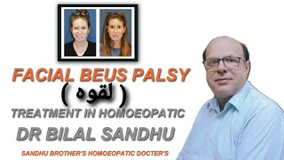 Facial Bells palsy  لقوہ  Treatment in Homoeopathic Medicine Dr Bilal Sandhu [upl. by Nylaras]