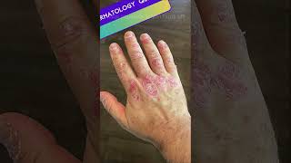 Dermatoses Resulting from Physical Factors Quiz  Part 2 medicalmcqs dermatologyquiz [upl. by Germano772]