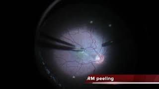 RPERetina Hamartoma Vitrectomy [upl. by Ambrosi23]