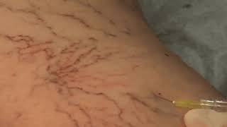 Visual Sclerotherapy on Spider Veins [upl. by Attikin616]