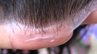 Complete hair solutionscouk Affordable non surgical hair replacementMr Blue sky [upl. by Ayeki]