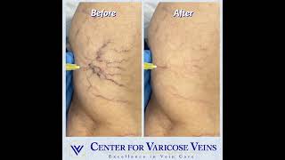 Spider Vein Injections [upl. by Prochoras]