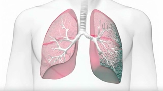 Idiopathic Pulmonary Fibrosis IPF Risk Factors and Diagnosis [upl. by Papst]