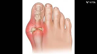 gouty arthritis and rheumatoid arthritis  osteoarthritis amp rheumatoid arthritis [upl. by Hait501]