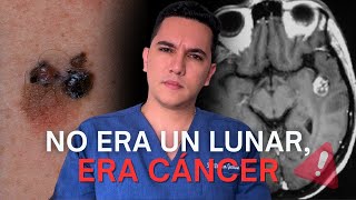 Creyó que era un lunar y resultó ser un cáncer en la piel que le causó metástasis en el cerebro [upl. by Ecirtak]