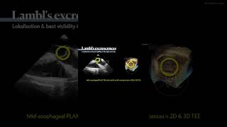 Lambls excrescences amp fibroelastoma in TEE 🫀 [upl. by Biamonte]